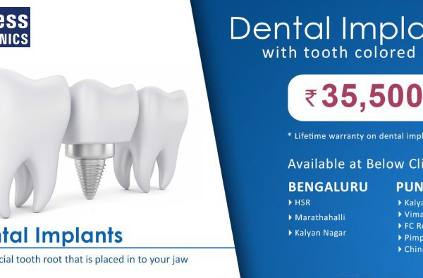 Dental Implants Best Implantologist