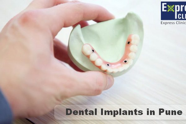 Dentist in Pune | Dental Clinic – Cosmetics and Implant