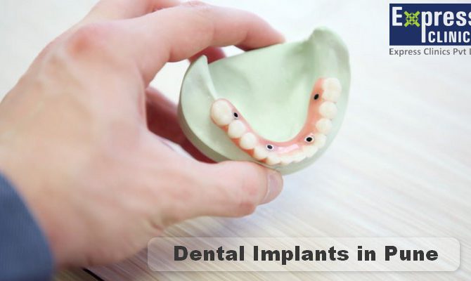 Dentist in Pune | Dental Clinic – Cosmetics and Implant